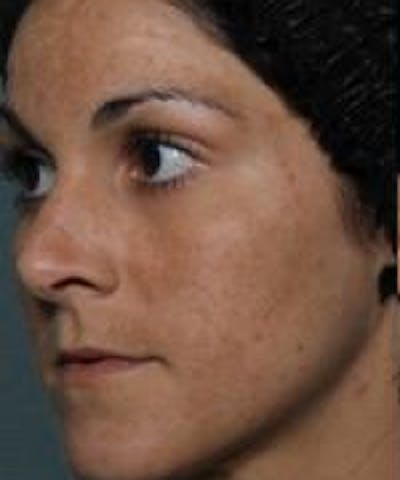 Melasma Before & After Gallery - Patient 5930361 - Image 1