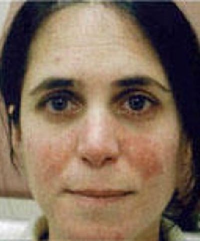 Acne & Rosacea Before & After Gallery - Patient 5930358 - Image 1