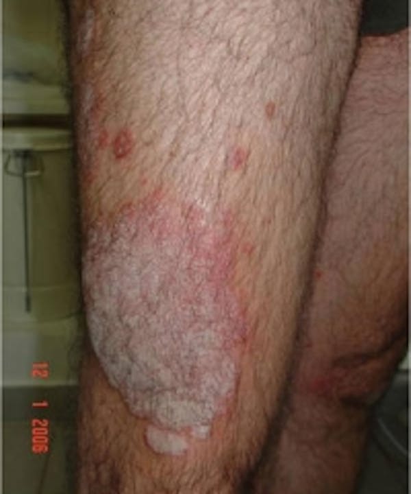 Psoriasis Before & After Gallery - Patient 5930359 - Image 1
