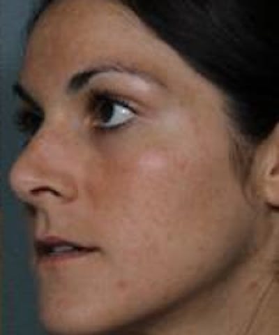 Melasma Before & After Gallery - Patient 5930361 - Image 2