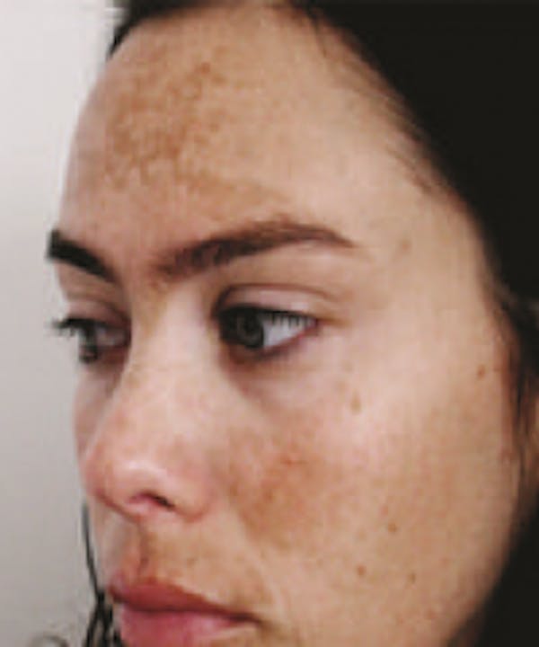 Melasma Before & After Gallery - Patient 5930361 - Image 3