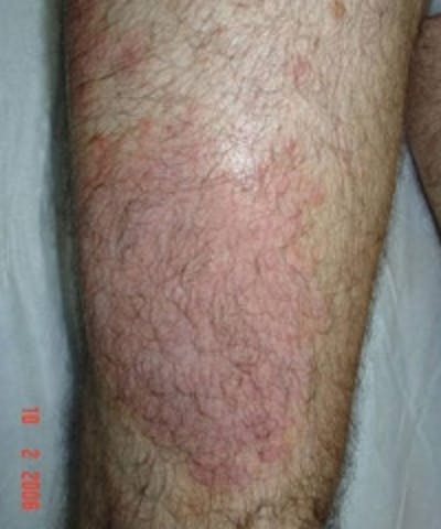 Psoriasis Before & After Gallery - Patient 5930359 - Image 2
