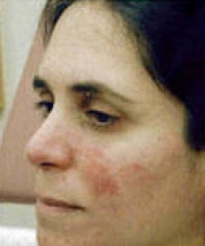 Acne & Rosacea Before & After Gallery - Patient 5930360 - Image 1