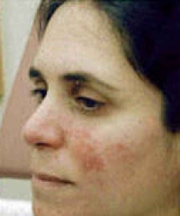 Acne & Rosacea Before & After Gallery - Patient 5930360 - Image 1