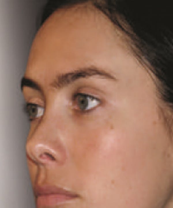 Melasma Before & After Gallery - Patient 5930361 - Image 4