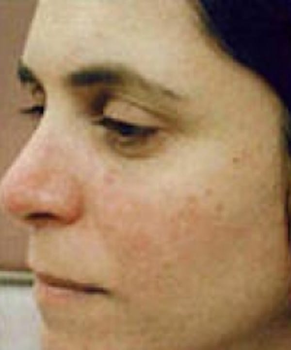 Acne & Rosacea Before & After Gallery - Patient 5930360 - Image 2