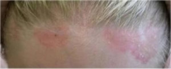 Psoriasis Before & After Gallery - Patient 5930363 - Image 1