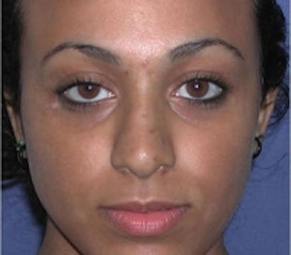 Vitiligo Before & After Gallery - Patient 5930362 - Image 2