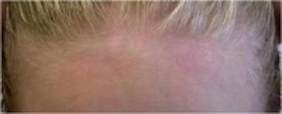 Psoriasis Before & After Gallery - Patient 5930363 - Image 2