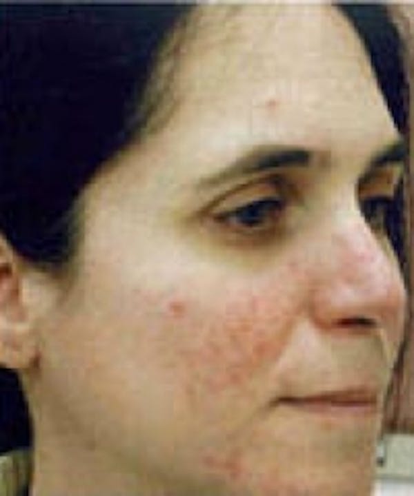 Acne & Rosacea Before & After Gallery - Patient 5930364 - Image 1