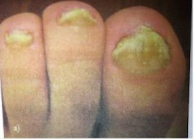 Toe Nail Fungus Before & After Gallery - Patient 5930365 - Image 1