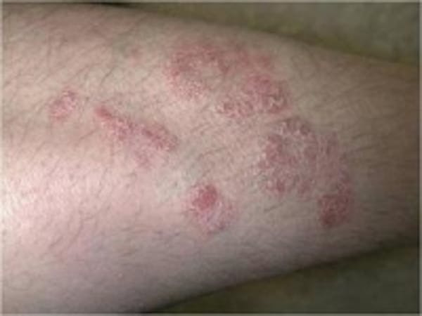 Psoriasis Before & After Gallery - Patient 5930366 - Image 1