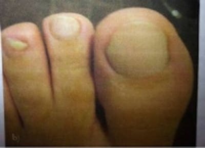 Toe Nail Fungus Before & After Gallery - Patient 5930365 - Image 2