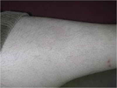 Psoriasis Before & After Gallery - Patient 5930366 - Image 2