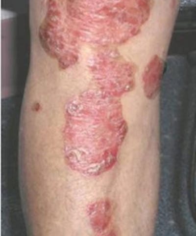 Psoriasis Before & After Gallery - Patient 5930369 - Image 1