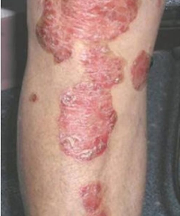 Psoriasis Before & After Gallery - Patient 5930369 - Image 1