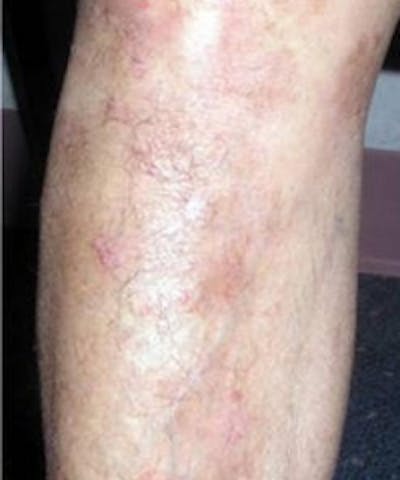 Psoriasis Before & After Gallery - Patient 5930369 - Image 2