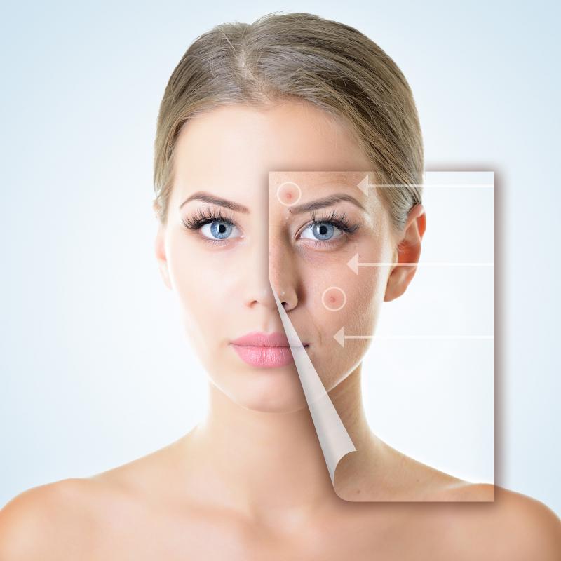 JUVA Skin & Laser Center Blog | How Can I Get Rid of My Acne Scars?