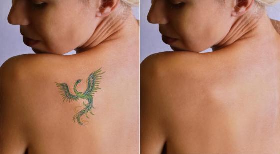 JUVA Skin & Laser Center Blog | Tired of Those Tattoos?