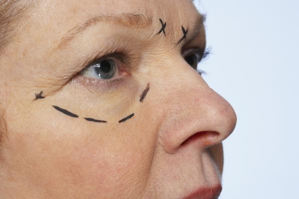 JUVA Skin & Laser Center Blog | Is the Madonna Eyelift or Eyelid Surgery Right For You?