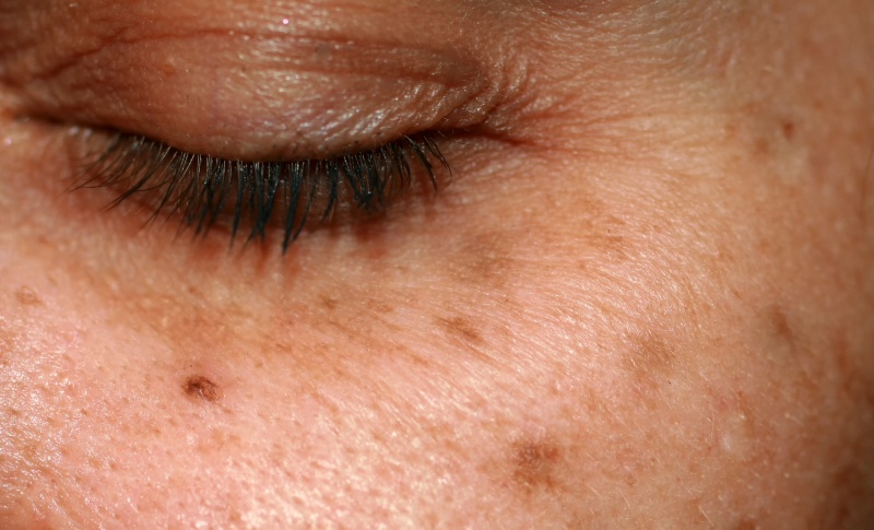 JUVA Skin & Laser Center Blog | Revlite Laser: The Magic Wand That Treats Age Spots