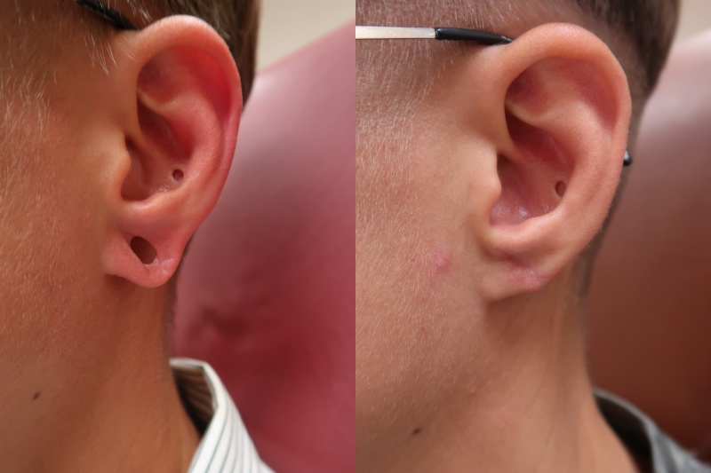 JUVA Skin & Laser Center Blog | Is Earlobe Repair A Real Thing?