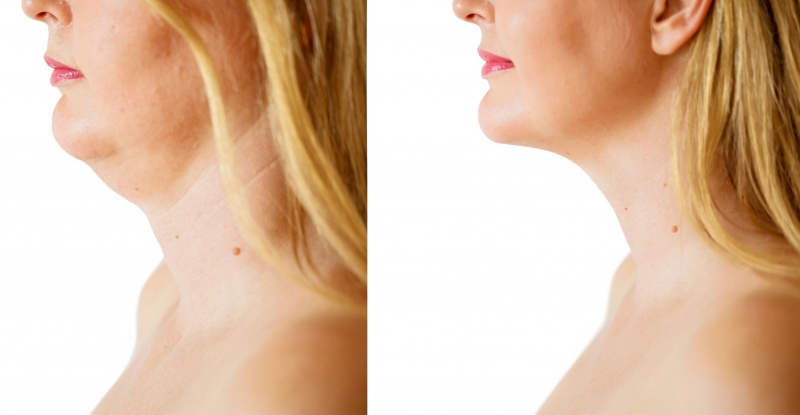 JUVA Skin & Laser Center Blog | Does Your Double Chin Have You Down On Luck? Kybella Is The Ultimate Pick Me Up For the Chin