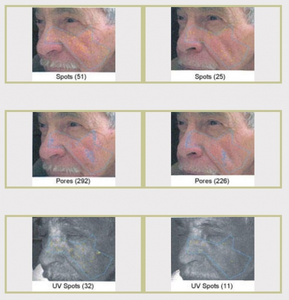 JUVA Skin & Laser Center Blog | VISIA: Genie Lamp, Tell Me My True Skin's Age?