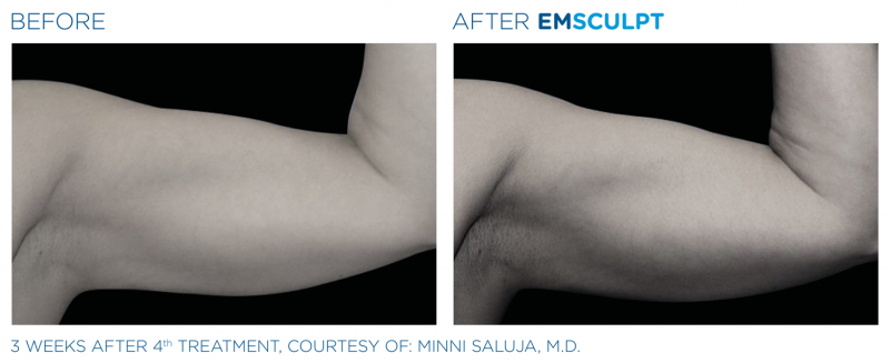 JUVA Skin & Laser Center Blog | Building Your Arms (Biceps and Triceps) With Emsculpt