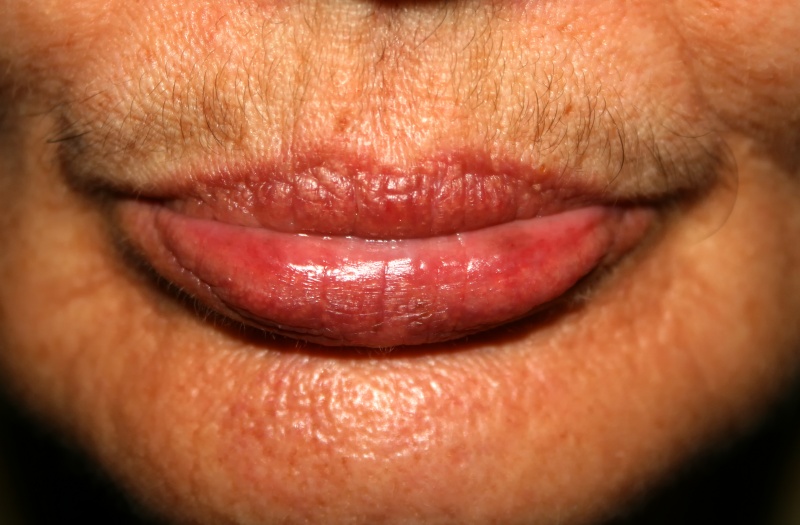 JUVA Skin & Laser Center Blog | How Do I Get Rid of My Embarrassing Upper Lip Mustache? Laser Hair Removal Is The Answer