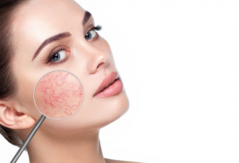 JUVA Skin & Laser Center Blog | Pulsed Dye Laser (PDL) For Facial Redness