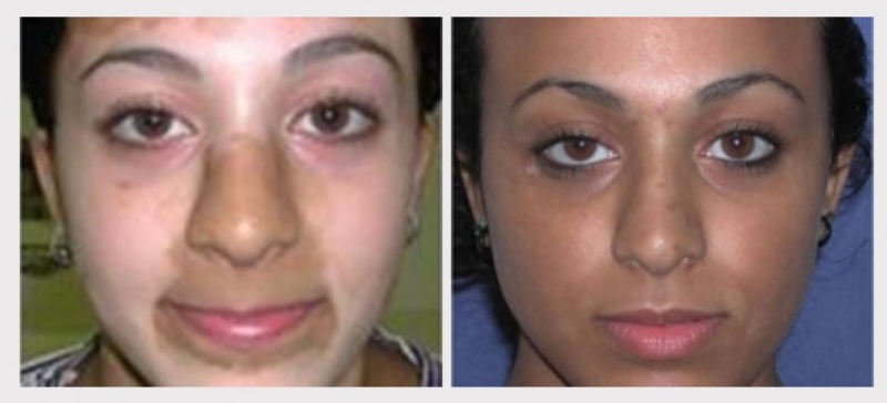 JUVA Skin & Laser Center Blog | Everything You Need to Know About Vitiligo and the Xtrac Laser