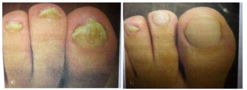 JUVA Skin & Laser Center Blog | How to Address Toenail Fungus the Correct Way