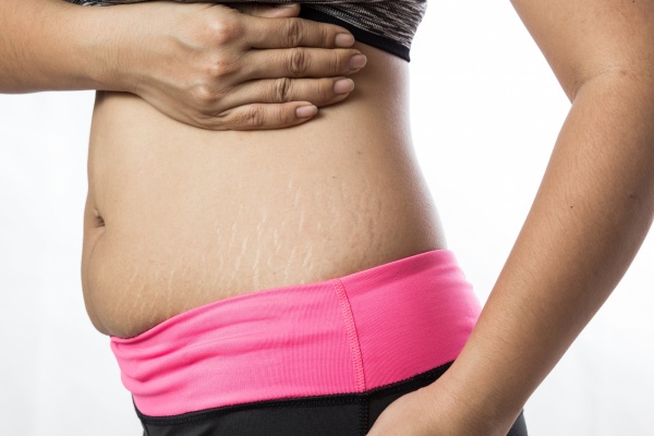 JUVA Skin & Laser Center Blog | What Causes Stretch Marks?