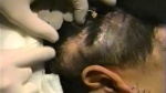 JUVA Skin & Laser Center Blog | Hair Transplant - NBC - Dr. Bruce Katz