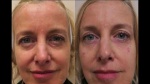 JUVA Skin & Laser Center Blog | Treatment of Under Eye Dark Circles and Bags with Restylane Filler