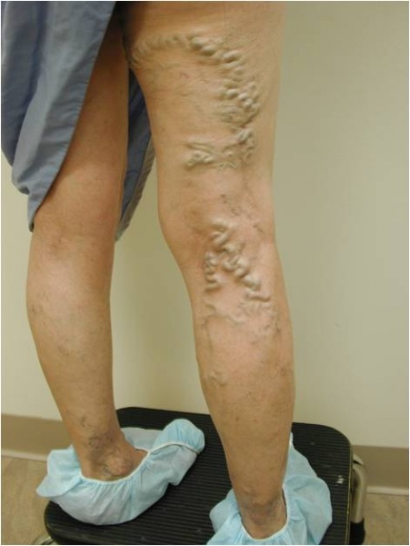 JUVA Skin & Laser Center Blog | Ambulatory Phlebectomy for Varicose Veins