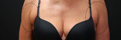 Non-Invasive Fat Removal Before & After Gallery - Patient 6735071 - Image 1