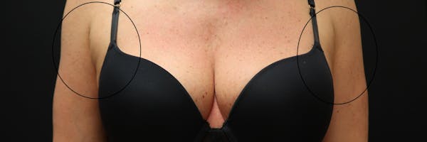 Non-Invasive Fat Removal Before & After Gallery - Patient 6735071 - Image 2