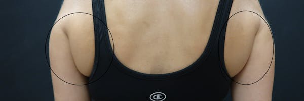 Non-Invasive Fat Removal Before & After Gallery - Patient 6735070 - Image 1