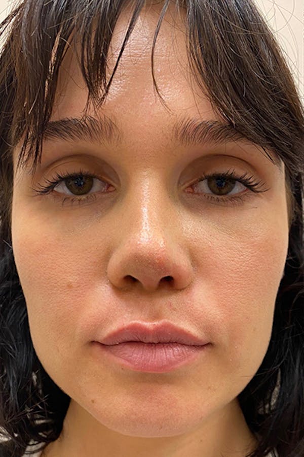 Before and after dermal fillers in NYC at JUVA Skin & Laser Center