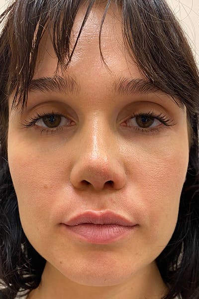 Fillers Before & After Gallery - Patient 7461468 - Image 1