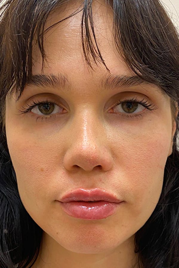 Before and after dermal fillers in NYC at JUVA Skin & Laser Center