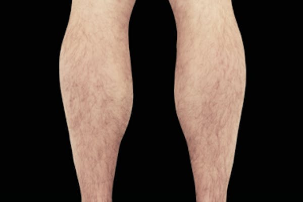 Muscle Building Before & After Gallery - Patient 7626746 - Image 1