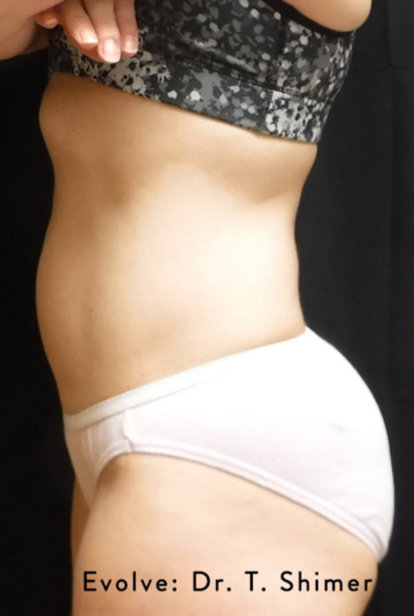 Non-Invasive Fat Removal Before & After Gallery - Patient 7626768 - Image 2