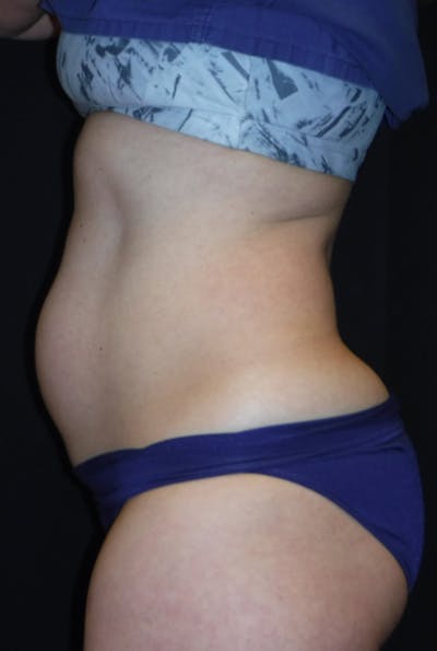 Non-Invasive Fat Removal Before & After Gallery - Patient 7626768 - Image 1