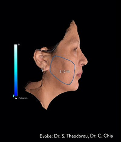 Facial Rejuvenation Before & After Gallery - Patient 7626780 - Image 1