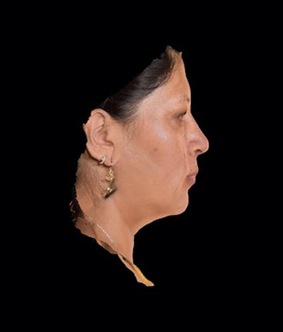 Facial Rejuvenation Gallery - Patient 7626780 - Image 2