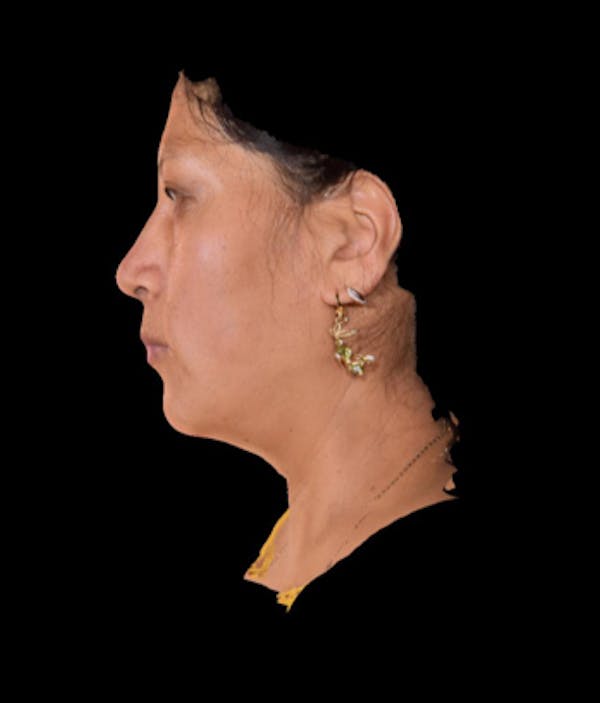 Facial Rejuvenation Before & After Gallery - Patient 7626780 - Image 3