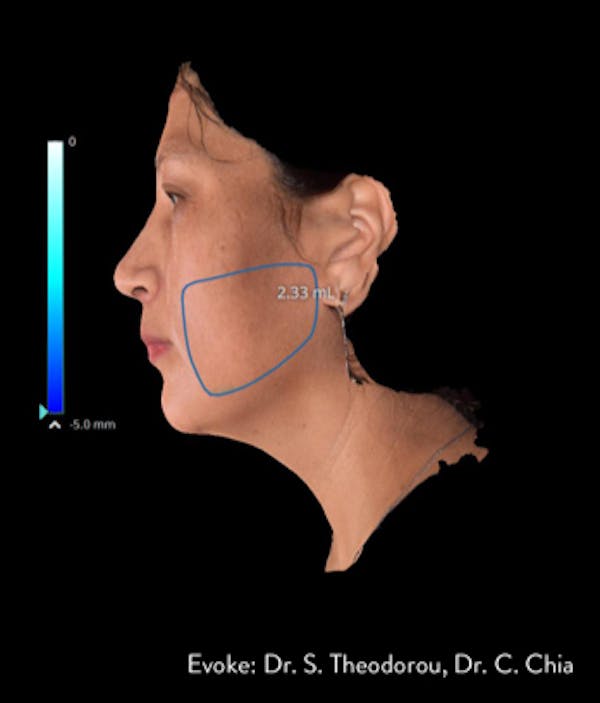 Facial Rejuvenation Before & After Gallery - Patient 7626780 - Image 4